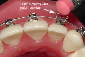 What to do if My Braces Wire Pokes Me?