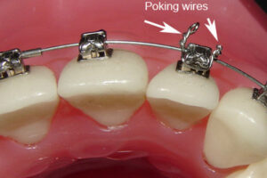 What to do when I have an orthodontic wire sticking out and poking the gums?