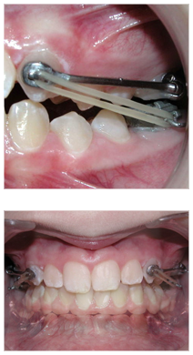 Carriere appliance on patients teeth