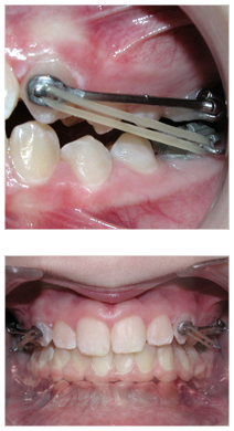 Carriere appliance on patients teeth