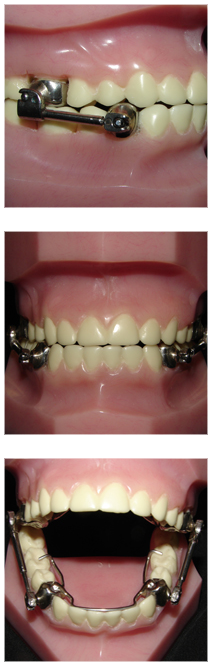 Carriere on teeth
