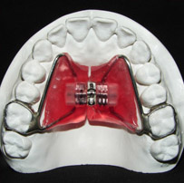 Upper palatal expander